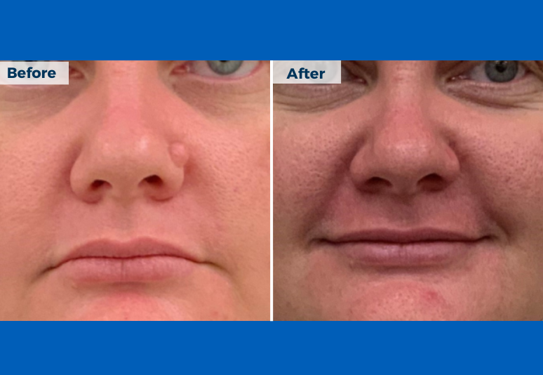 Mole removal Skin Clinic, Australia